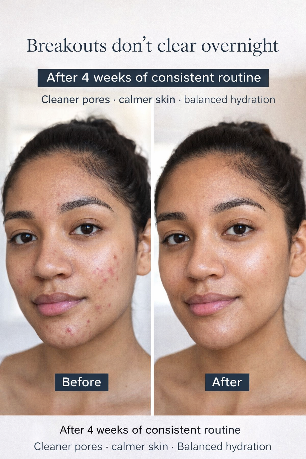 Acne-Control Hydration Routine (COSRX Low pH Good Morning Gel Cleanser • The Ordinary Salicylic Acid 2% Solution • COSRX Advanced Snail 96 Mucin Power Essence • Neutrogena Hydro Boost Water Gel)