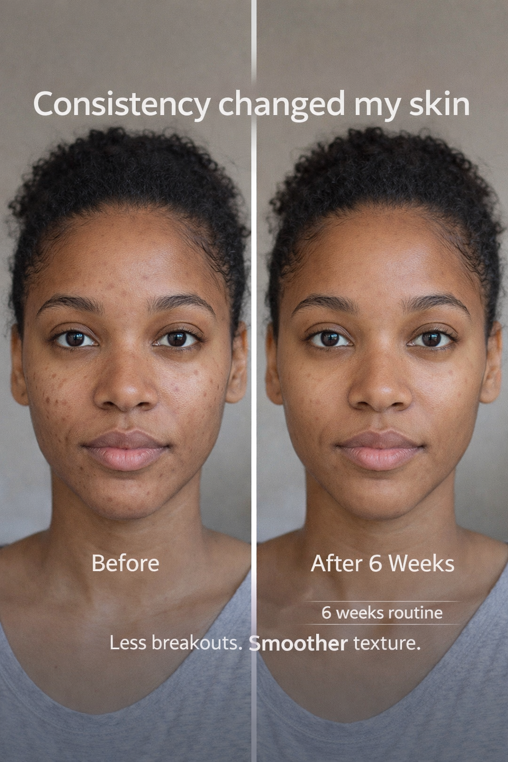 CeraVe Acne & Barrier Repair Routine (Foaming Facial Cleanser • Resurfacing Retinol Serum • Moisturising Cream)